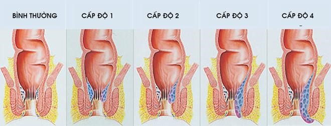 Các giai đoạn của người mắc bệnh trĩ